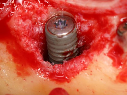 greffe et implantation simultanée