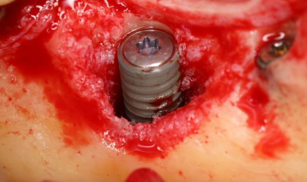 greffe et implantation simultanée