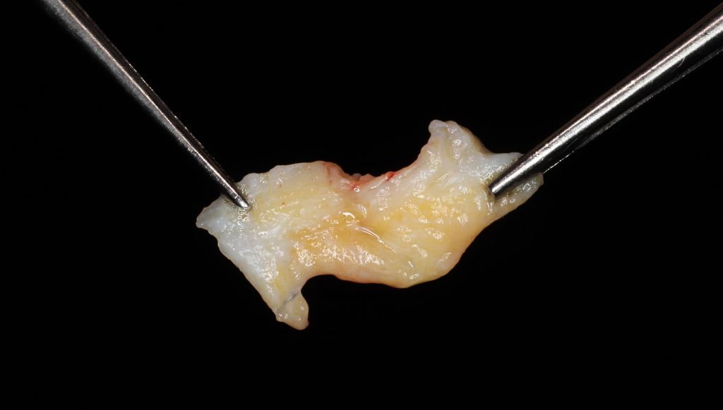 Augmentations osseuses en implantologie : la gestion des tissus mous