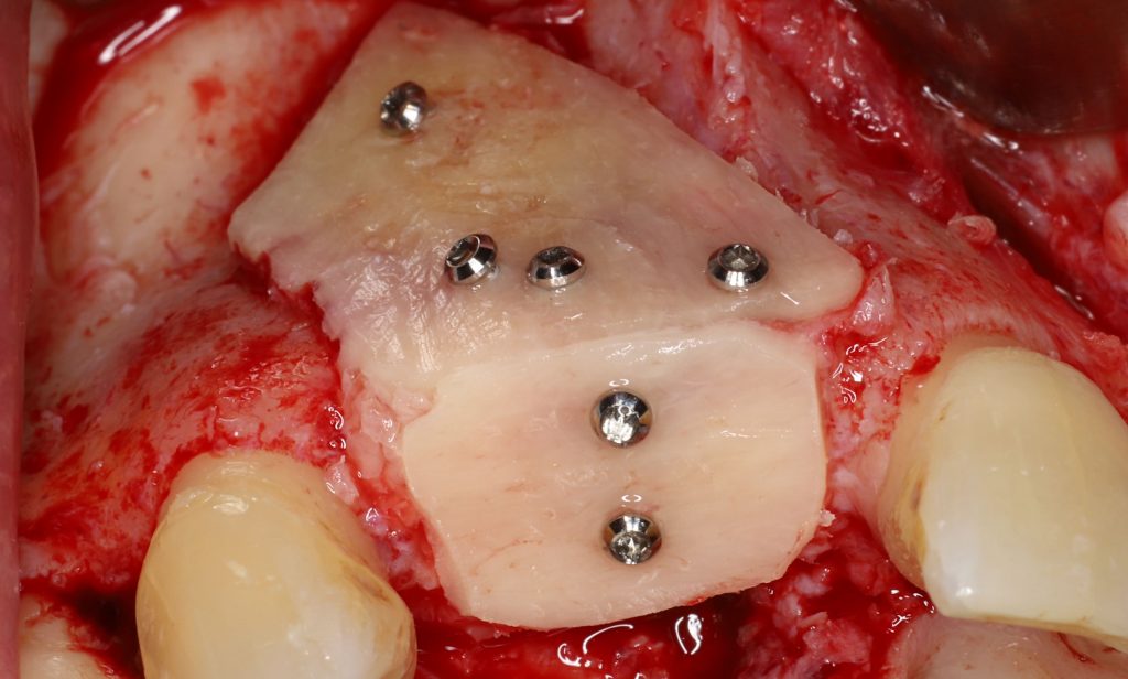 Augmentations osseuses en implantologie: la shell technique