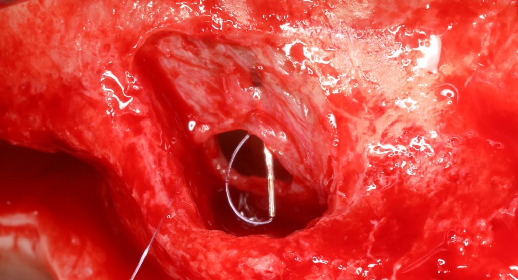 Augmentations osseuses en implantologie: sinuslift internes et externes
