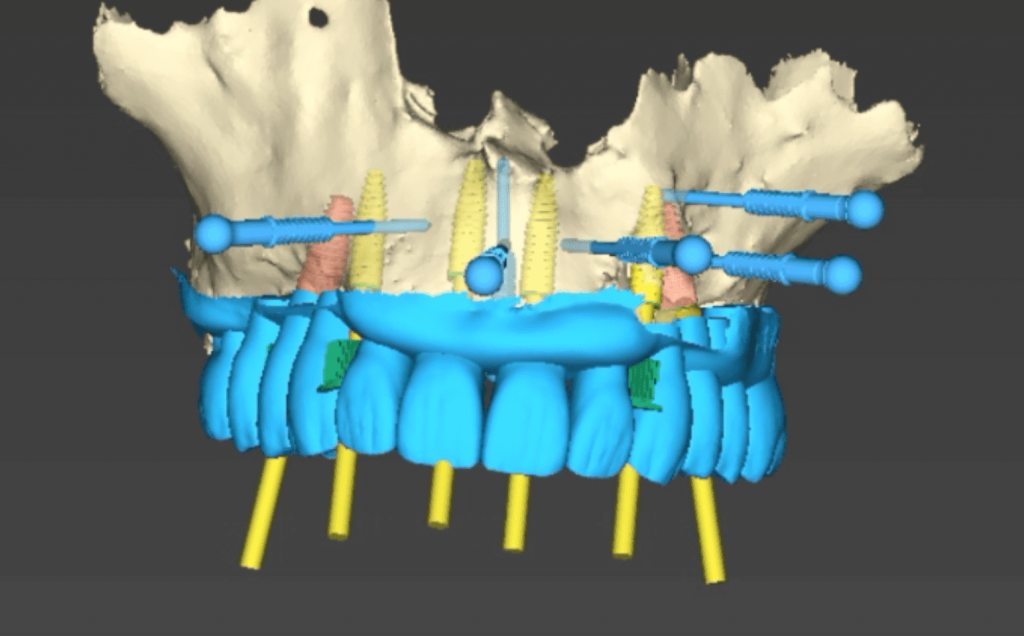 Implants & Digital Workflow:  Progresser