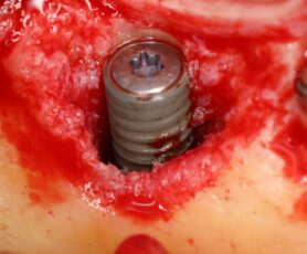 greffe et implantation simultanée